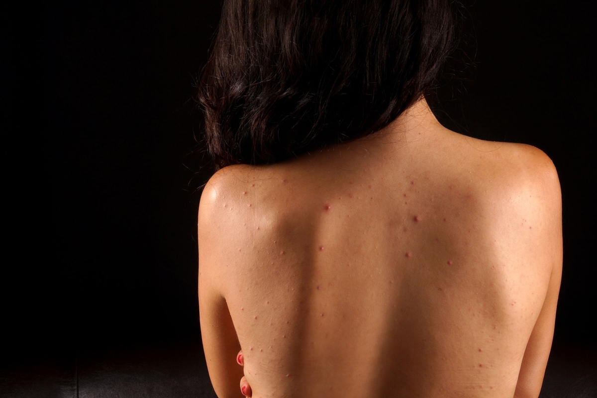 a woman showing her back acne