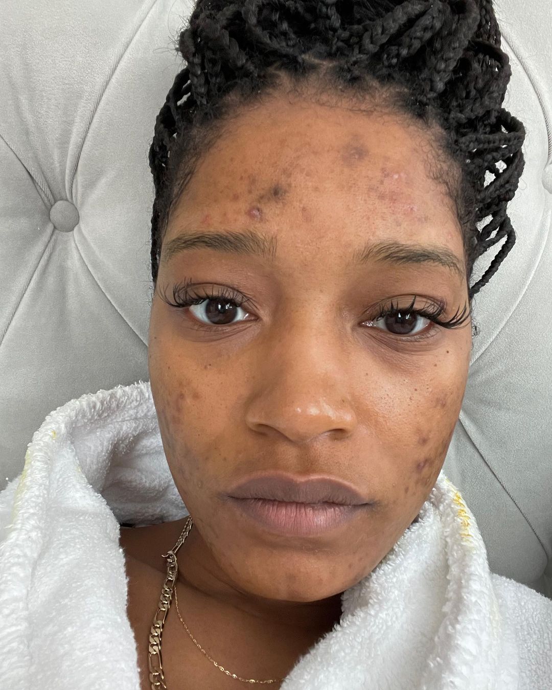 Keke Palmer showing her acne scars