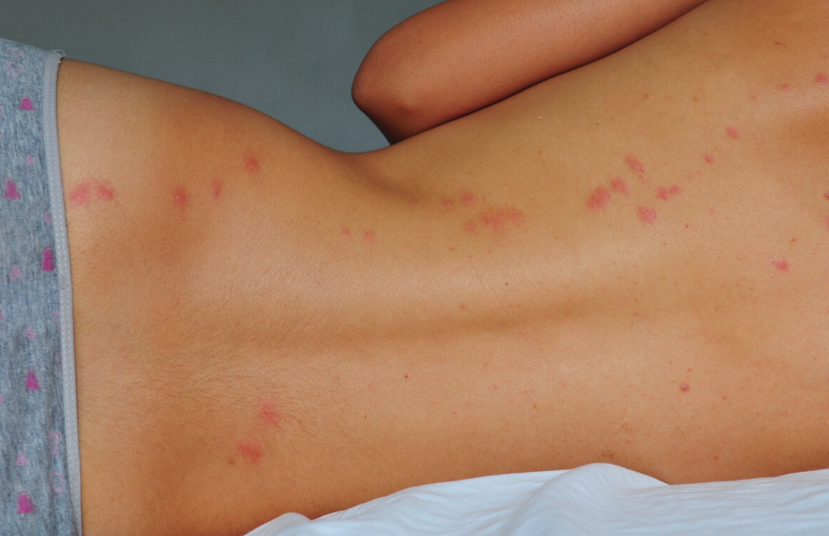 a girl showing her bed bug bites