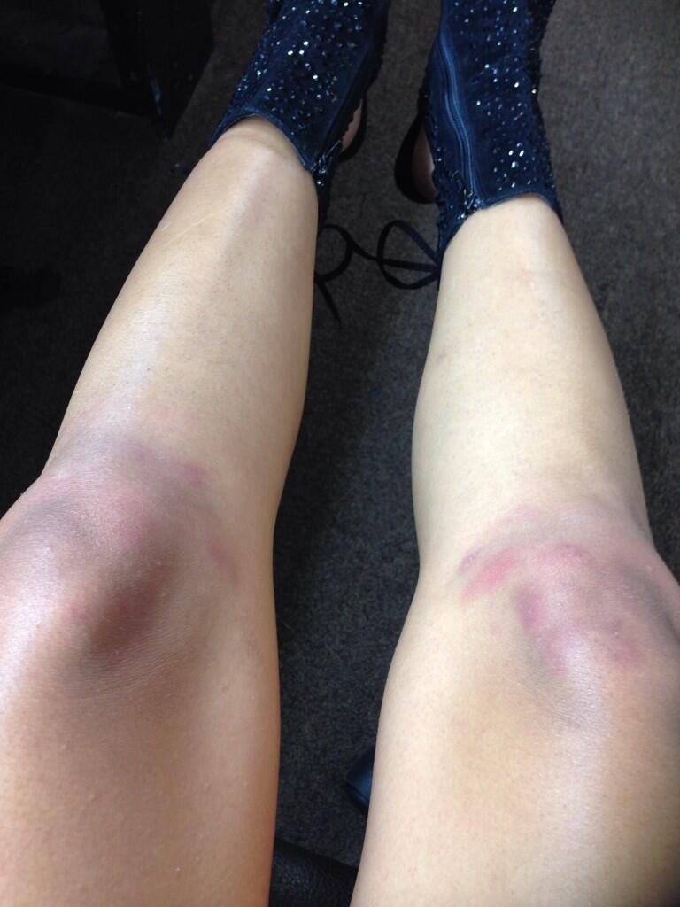 Gulliana Alexis showing her bruised knees
